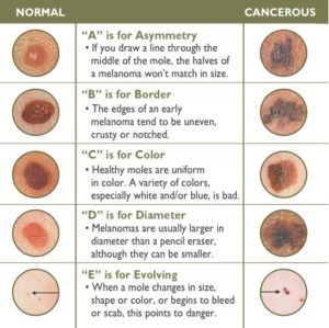 How To Identify Skin Cancer | Tips From Jacket Sunscreen